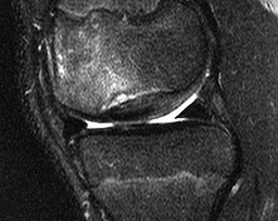 Knee OCD Case MRI 2